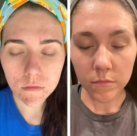 BIOAQUA Salicylic Acid Acne Repair Cream